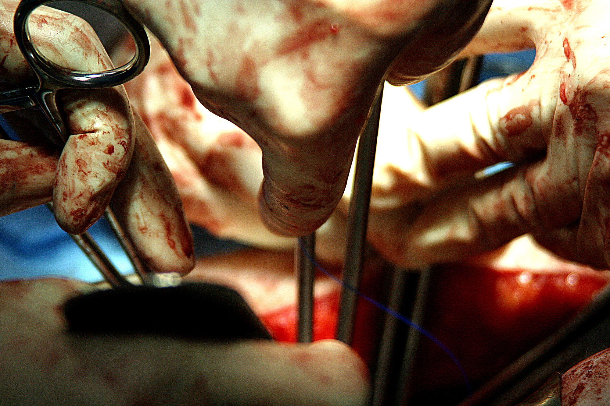 Obgyn Surgery Pi Modified